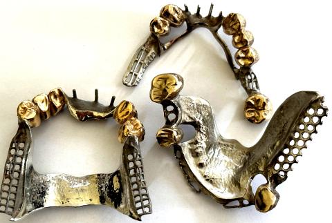 Zahngold mit Zahnspange und Brücke